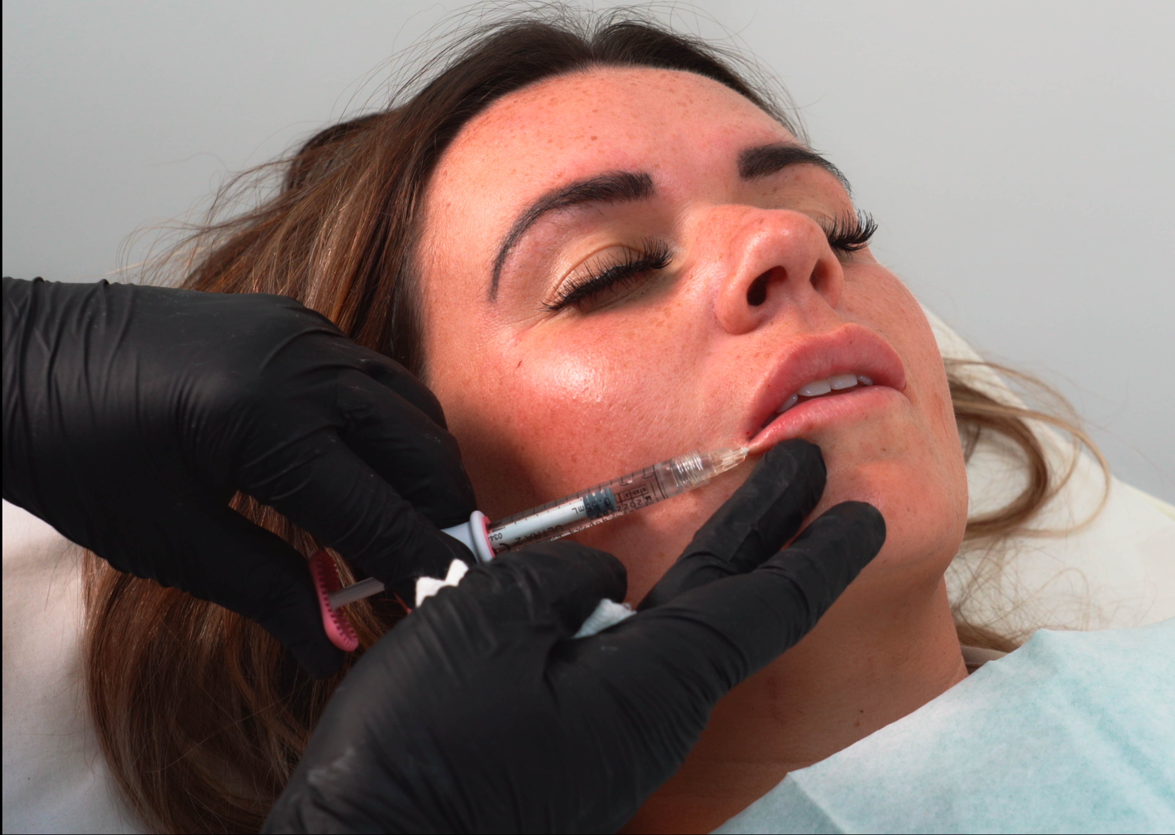 Advanced Lips & Marionette Lines With Cannula